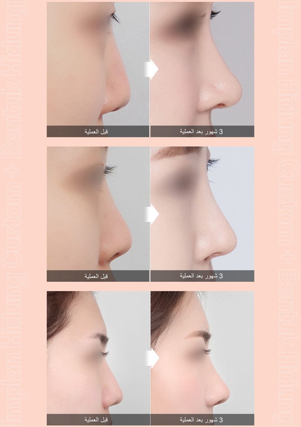 nose06_img